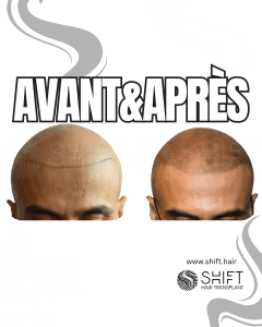 Avant Après de la micropigmentation du cuir chevelu pour un look rasé en Turquie chez SHIFT Hair à Istanbul 03 3
