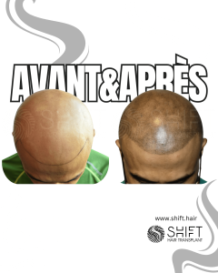 Avant Après de la micropigmentation du cuir chevelu pour un look rasé en Turquie chez SHIFT Hair à Istanbul 04 3