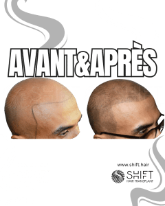 Avant Après de la micropigmentation du cuir chevelu pour un look rasé en Turquie chez SHIFT Hair à Istanbul 05 3