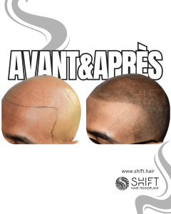 Avant Après de la micropigmentation du cuir chevelu pour un look rasé en Turquie chez SHIFT Hair à Istanbul 06 3