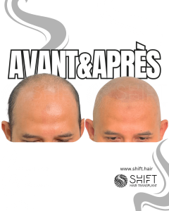 Avant Après de la micropigmentation du cuir chevelu pour un look rasé en Turquie chez SHIFT Hair à Istanbul 07 3
