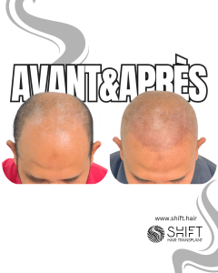 Avant Après de la micropigmentation du cuir chevelu pour un look rasé en Turquie chez SHIFT Hair à Istanbul 08 3