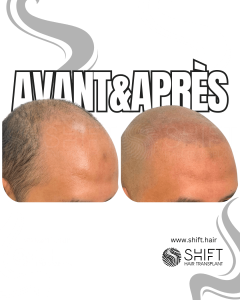 Avant Après de la micropigmentation du cuir chevelu pour un look rasé en Turquie chez SHIFT Hair à Istanbul 09 3