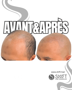 Avant Après de la micropigmentation du cuir chevelu pour un look rasé en Turquie chez SHIFT Hair à Istanbul 10 3