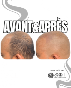 Avant Après de la micropigmentation du cuir chevelu pour un look rasé en Turquie chez SHIFT Hair à Istanbul 11 3