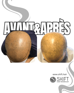 Avant Après de la micropigmentation du cuir chevelu pour un look rasé en Turquie chez SHIFT Hair à Istanbul 12 3