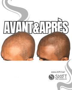 Avant Après de la micropigmentation du cuir chevelu pour un look rasé en Turquie chez SHIFT Hair à Istanbul 16 3