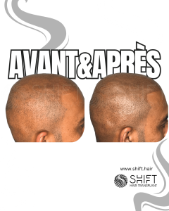 Avant Après de la micropigmentation du cuir chevelu pour un look rasé en Turquie chez SHIFT Hair à Istanbul 17 3