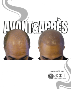 Avant Après de la micropigmentation du cuir chevelu pour un look rasé en Turquie chez SHIFT Hair à Istanbul 19 3