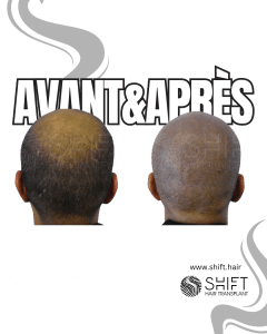 Avant Après de la micropigmentation du cuir chevelu pour un look rasé en Turquie chez SHIFT Hair à Istanbul 20 3
