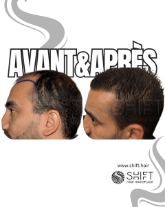 Avant Après de la zone donneuse après une greffe de cheveux en Turquie chez SHIFT Hair à Istanbul 01 3