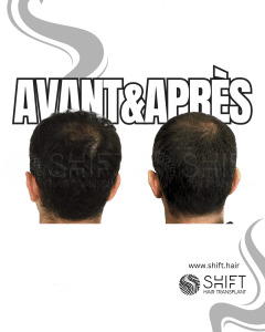 Avant Après de la zone donneuse après une greffe de cheveux en Turquie chez SHIFT Hair à Istanbul 02 3