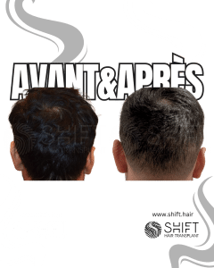 Avant Après de la zone donneuse après une greffe de cheveux en Turquie chez SHIFT Hair à Istanbul 03 3