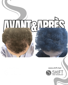 Avant Après du traitement de mésothérapie capillaire en Turquie chez SHIFT Hair à Istanbul 01 3
