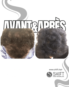 Avant Après du traitement de mésothérapie capillaire en Turquie chez SHIFT Hair à Istanbul 02 3