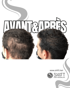 Avant Après d'une micropigmentation du cuir chevelu pour la zone donneuse après une greffe de cheveux en Turquie chez SHIFT Hair à Istanbul 01 3