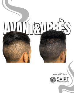 Avant Après d'une micropigmentation du cuir chevelu pour la zone donneuse après une greffe de cheveux en Turquie chez SHIFT Hair à Istanbul 02 3