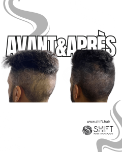 Avant Après d'une micropigmentation du cuir chevelu pour la zone donneuse après une greffe de cheveux en Turquie chez SHIFT Hair à Istanbul 03 3