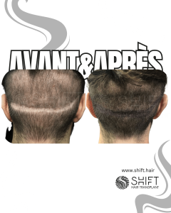 Avant Après d'une micropigmentation du cuir chevelu pour la zone donneuse après une greffe de cheveux en Turquie chez SHIFT Hair à Istanbul 05 3