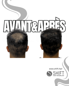 Avant Après d'une micropigmentation du cuir chevelu pour la zone donneuse après une greffe de cheveux en Turquie chez SHIFT Hair à Istanbul 06 3