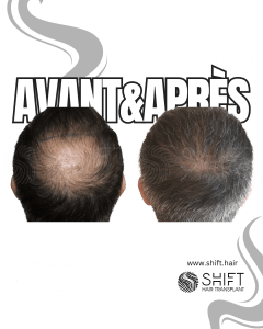 Avant Après la greffe de cheveux Crown en Turquie chez SHIFT Hair à Istanbul 01 3