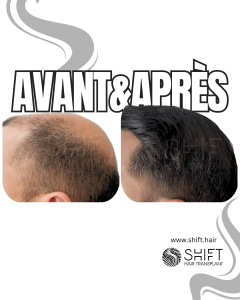 Avant Après la greffe de cheveux Crown en Turquie chez SHIFT Hair à Istanbul 02 3