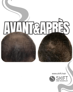 Avant Après la greffe de cheveux Crown en Turquie chez SHIFT Hair à Istanbul 03 3