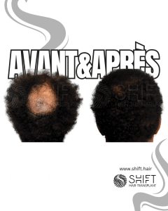 Avant Après la greffe de cheveux Crown en Turquie chez SHIFT Hair à Istanbul 04 3