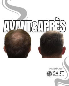 Avant Après la greffe de cheveux Crown en Turquie chez SHIFT Hair à Istanbul 05 3