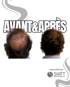 Avant Après la greffe de cheveux Crown en Turquie chez SHIFT Hair à Istanbul 06 3