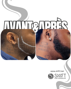 Avant Après une greffe de barbe afro en Turquie chez SHIFT Hair à Istanbul 03 3