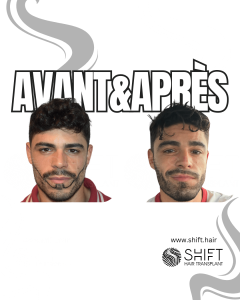 Avant Après une greffe de barbe en Turquie chez SHIFT Hair à Istanbul 01 3