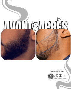 Avant Après une greffe de barbe en Turquie chez SHIFT Hair à Istanbul 04 3