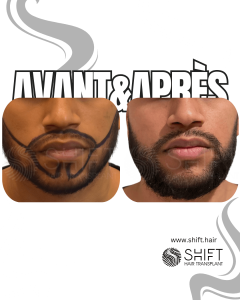 Avant Après une greffe de barbe en Turquie chez SHIFT Hair à Istanbul 05 3