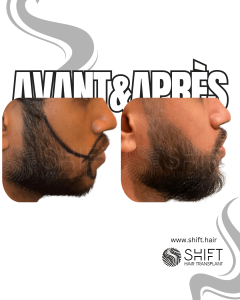 Avant Après une greffe de barbe en Turquie chez SHIFT Hair à Istanbul 06 3