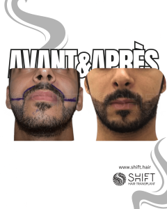 Avant Après une greffe de barbe en Turquie chez SHIFT Hair à Istanbul 08 3