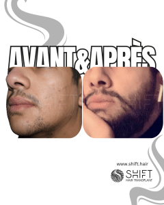 Avant Après une greffe de barbe en Turquie chez SHIFT Hair à Istanbul 09 3