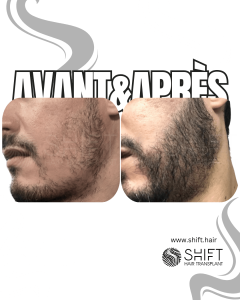 Avant Après une greffe de barbe en Turquie chez SHIFT Hair à Istanbul 10 3