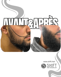 Avant Après une greffe de barbe en Turquie chez SHIFT Hair à Istanbul 12 3
