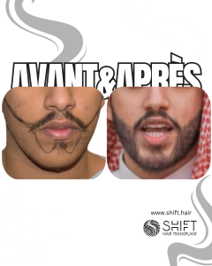 Avant Après une greffe de barbe en Turquie chez SHIFT Hair à Istanbul 14 3