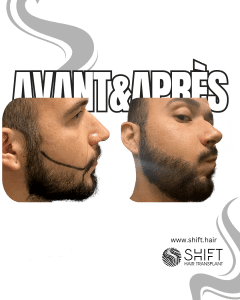 Avant Après une greffe de barbe en Turquie chez SHIFT Hair à Istanbul 15 3