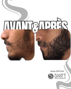 Avant Après une greffe de barbe en Turquie chez SHIFT Hair à Istanbul 16 3