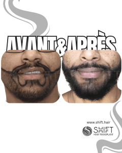 Avant Après une greffe de barbe en Turquie chez SHIFT Hair à Istanbul 17 3