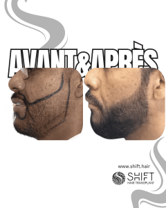 Avant Après une greffe de barbe en Turquie chez SHIFT Hair à Istanbul 19 3