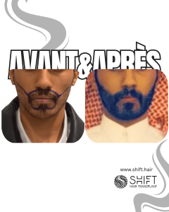 Avant Après une greffe de barbe en Turquie chez SHIFT Hair à Istanbul 22 3