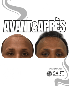 Avant Après une greffe de cheveux afro en Turquie chez SHIFT Hair à Istanbul 01 3