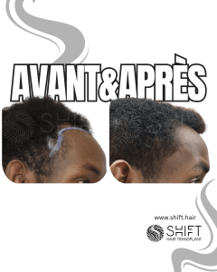 Avant Après une greffe de cheveux afro en Turquie chez SHIFT Hair à Istanbul 02 3