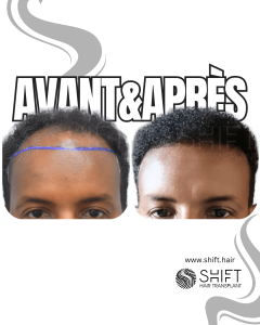 Avant Après une greffe de cheveux afro en Turquie chez SHIFT Hair à Istanbul 04 3