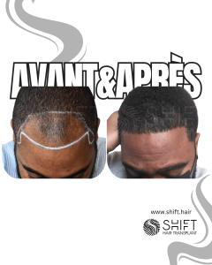Avant Après une greffe de cheveux afro en Turquie chez SHIFT Hair à Istanbul 05 3