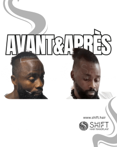 Avant Après une greffe de cheveux afro en Turquie chez SHIFT Hair à Istanbul 06 3
